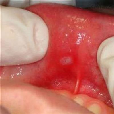 Red ulcer in mouth deals